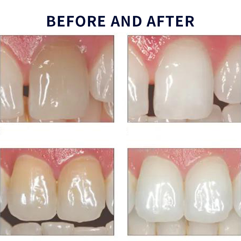 Opalescence Whitening 20% PF 2 - Teeth Whitening At Home Kit recensie en prijs