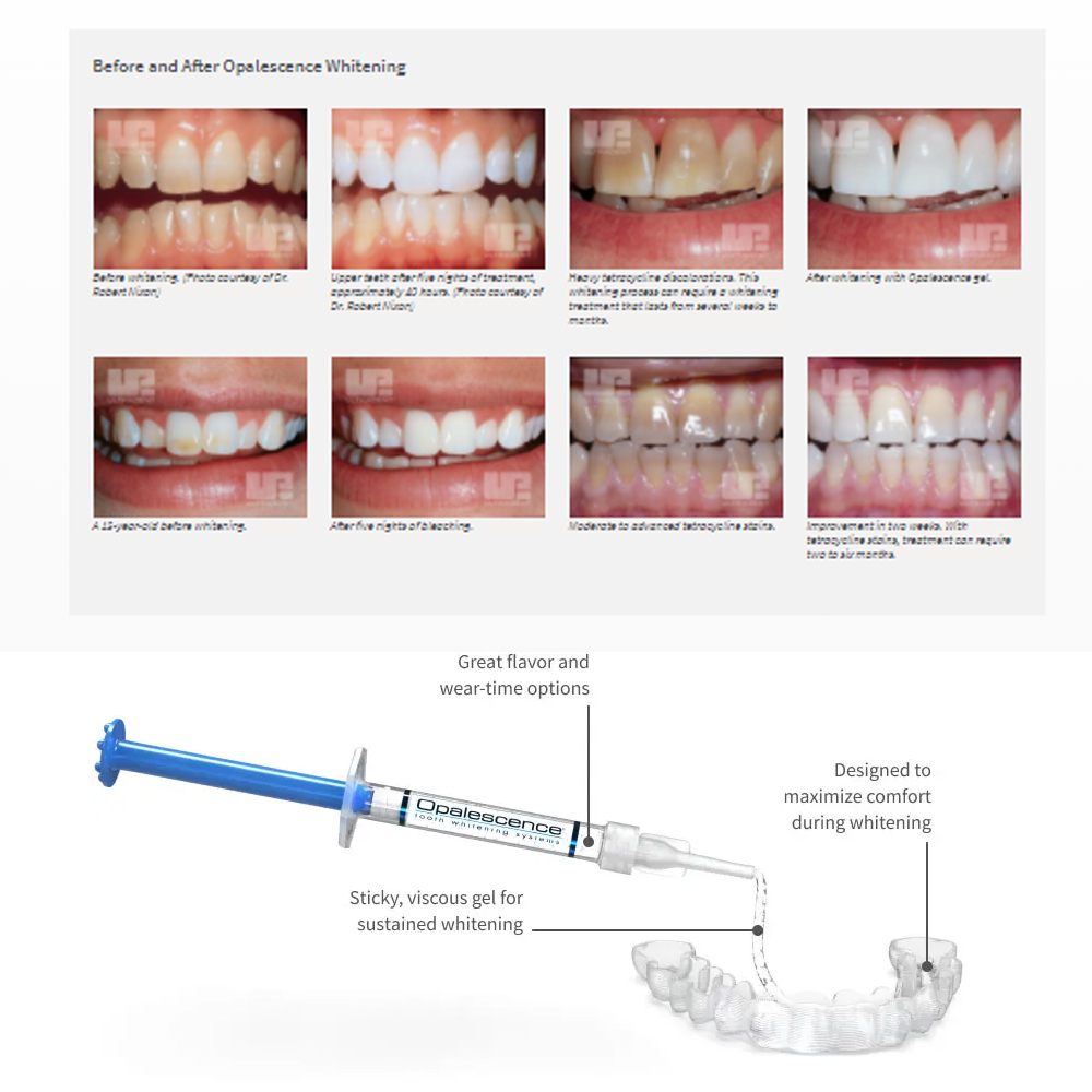 Opalescence Whitening 20% PF 2 - Teeth Whitening At Home Kit recensie en prijs