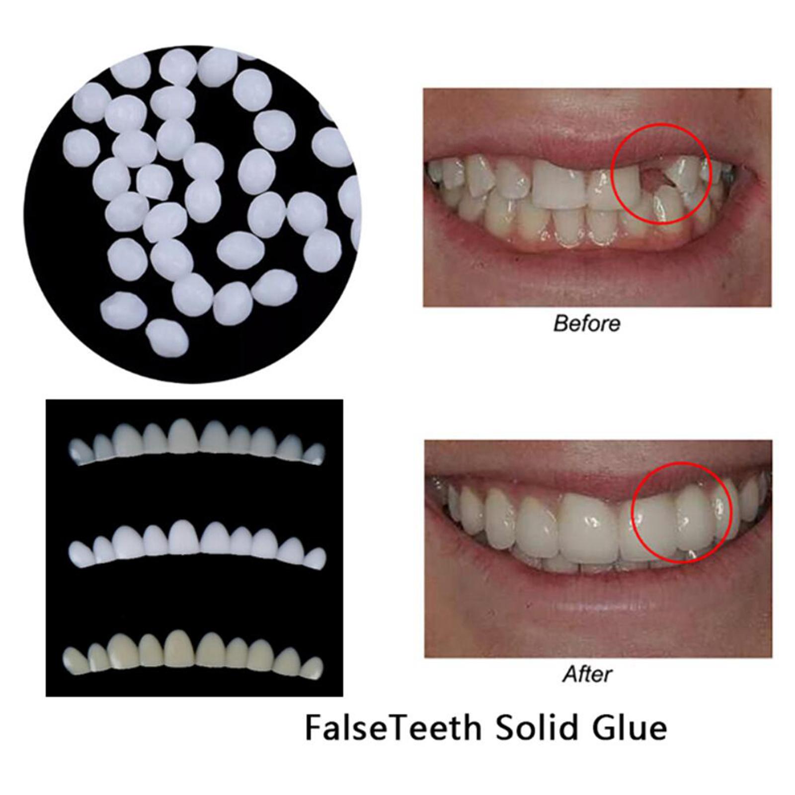 Temporary Teeth Whitening Kit  - Teeth Whitening At Home Kit recensie en prijs