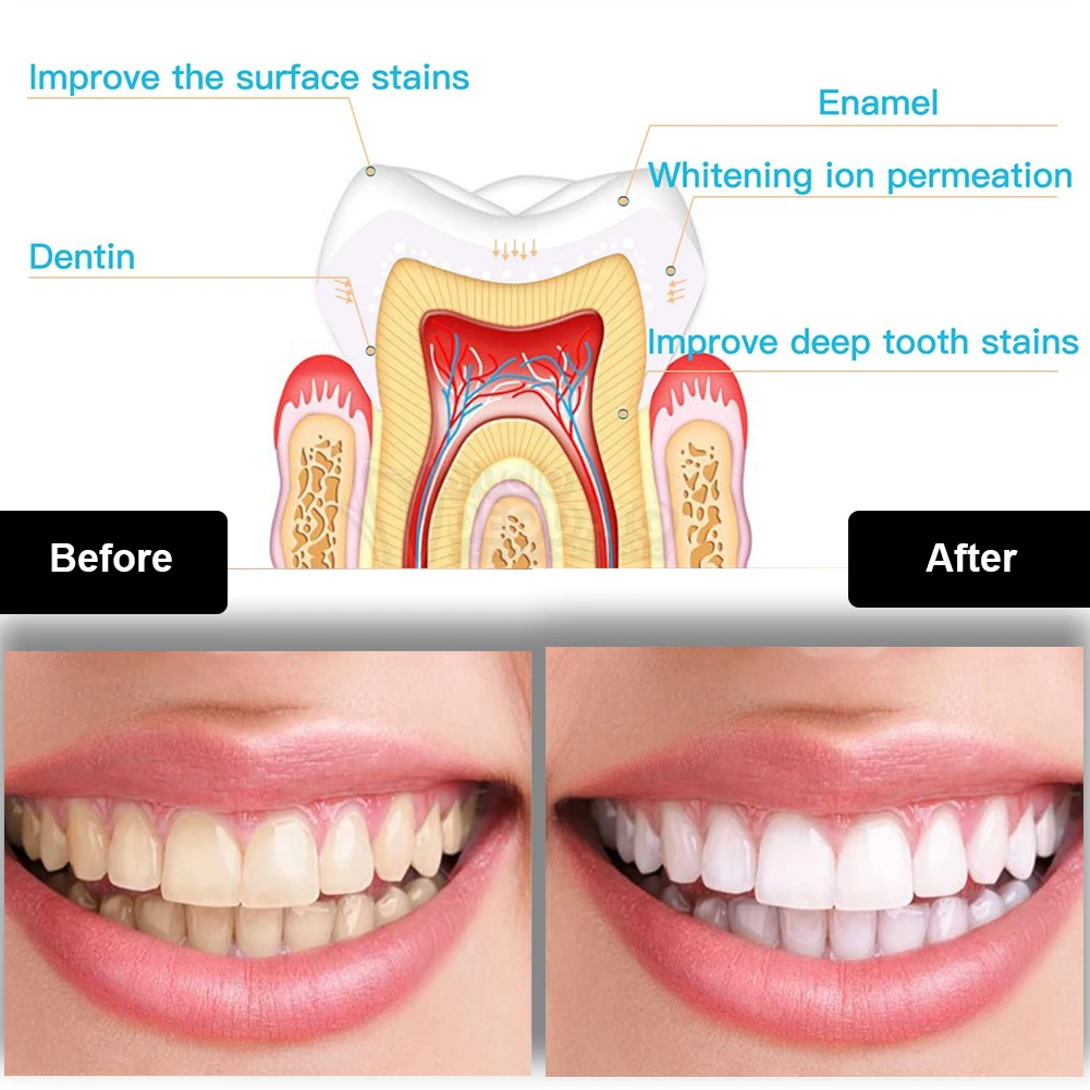 Dental Teeth Whitening Kit Min - Teeth Whitening Gel Pen recensie en prijs