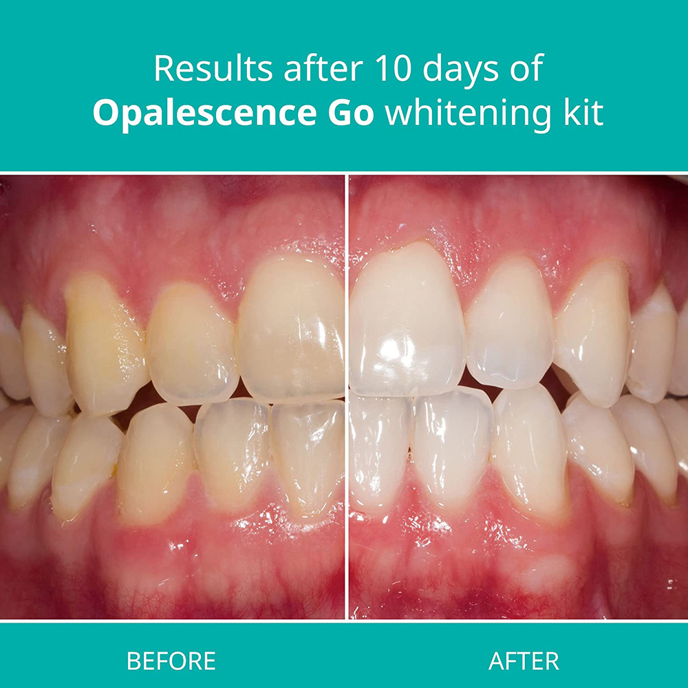 Opalescence Go Teeth Whitening - Teeth Whitening At Home Kit recensie en prijs